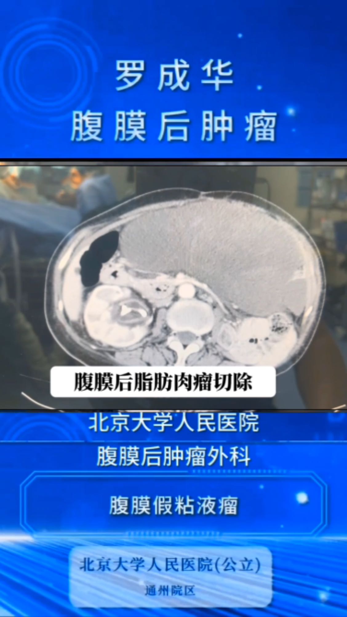 腹膜后脂肪肉瘤只要有一线希望,病人都会渴望治疗 腹膜后脂肪肉瘤
