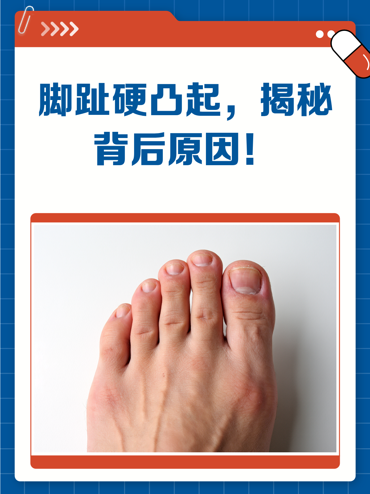 脚趾头长硬凸起?别急,一文教你辨明原因
