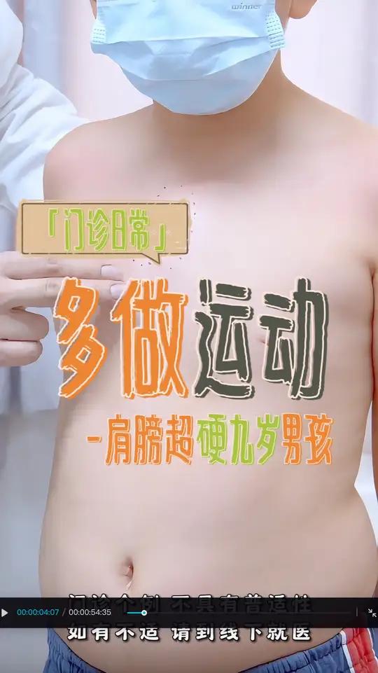 特别典型的B型鸡胸,这个小孩子年纪还小可以通过佩戴支具、运动改善