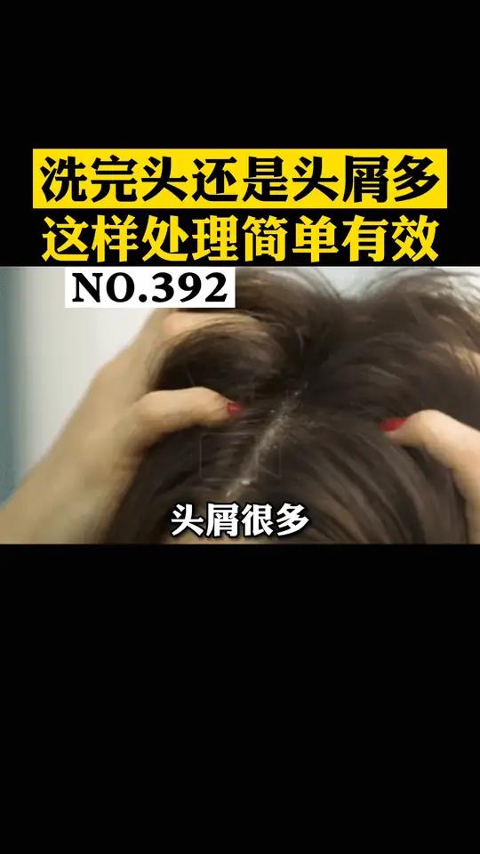 每天洗头,为什么头皮屑还那么多?试试这个办法