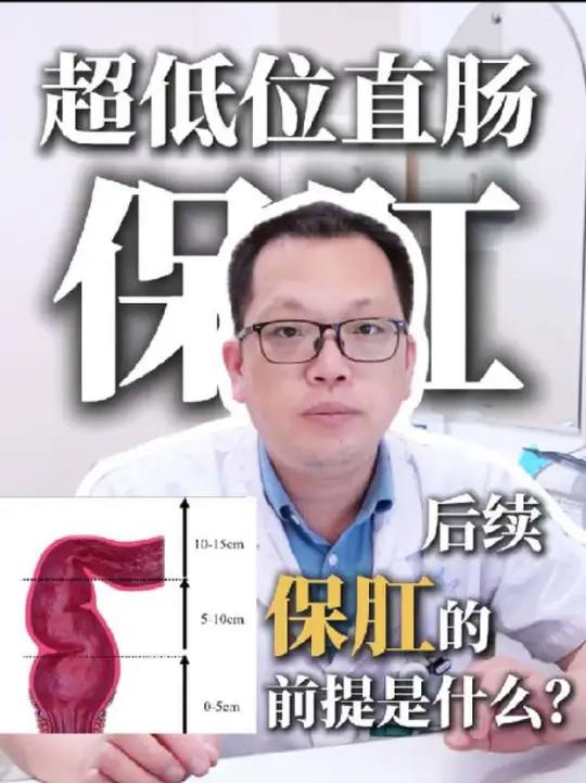 超低位直肠癌保肛,保肛的前提以及保肛需要的条件是什么呢?前几期视频中出现的患者已经顺利完成