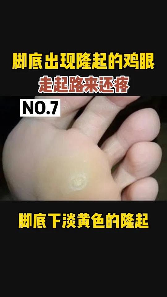 脚底长鸡眼,反反复复,走起路来还疼