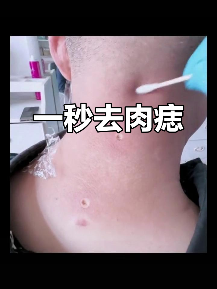 专业祛除大肉痣，效果立竿见影