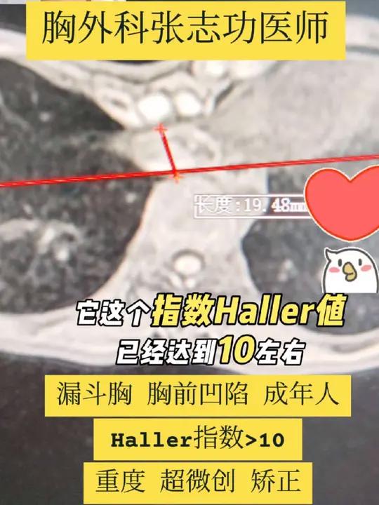 胸前凹陷,漏斗胸,Haller指数>10,重度,超微创漏矫正 胸前凹陷漏斗胸Haller指