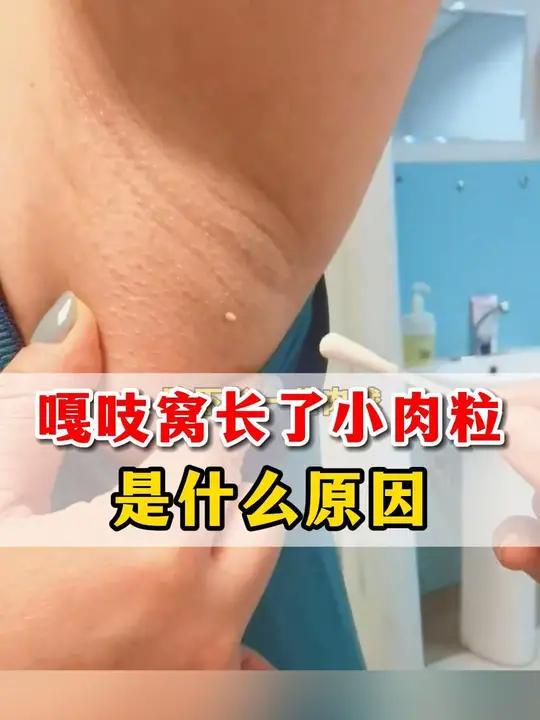 嘎吱窝小肉粒