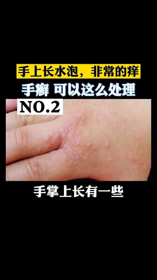 手上长红斑水疱,还瘙痒脱皮,手癣可以这样治