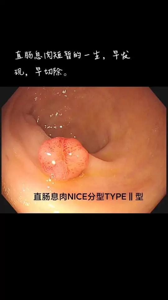 直肠息肉短暂的一生,早发现,早切除。