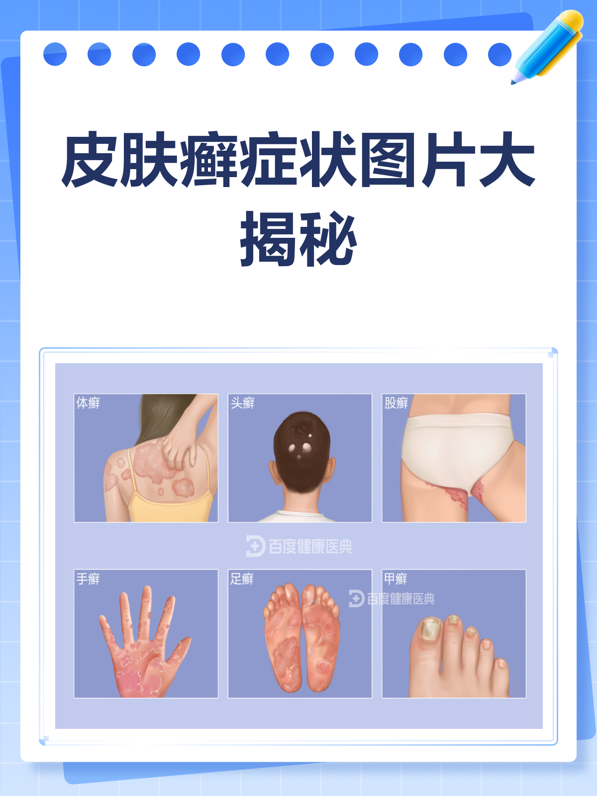 皮肤癣来袭?症状图片帮你一眼识别!