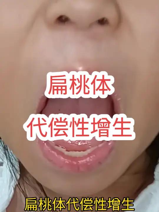 什么叫扁桃体代偿性增生 扁桃体代偿性增生能长多大?严重的仍然会打鼾憋气,术前详细评估非常重