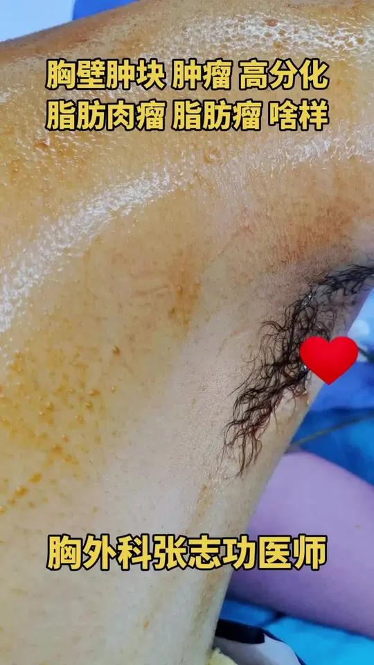 高分化 脂肪肉瘤脂肪瘤啥样