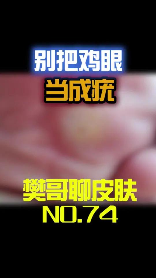 鸡眼还是疣傻傻分不清?这个视频帮您区分,这么办!