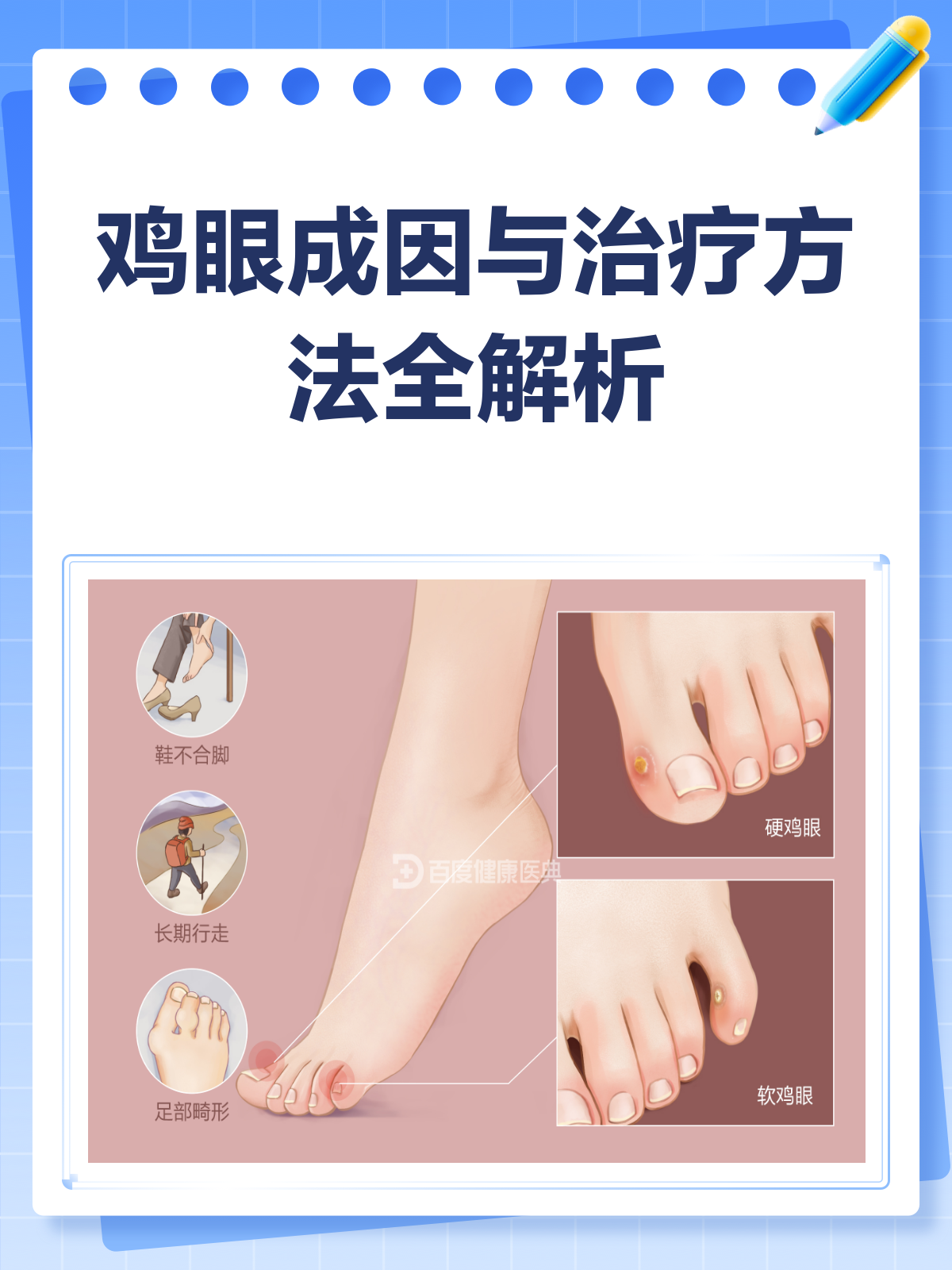 鸡眼烦恼?一文读懂原因与治疗方法