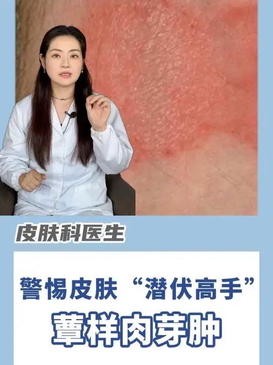 警惕皮肤 “潜伏高手”——蕈样肉芽肿 蕈样肉芽肿激素维A酸#靶向药
