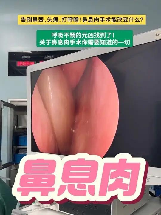 告别鼻塞、头痛、打呼噜！鼻息肉手术能改变什么？呼吸不畅的元凶找到了！关于鼻息肉手术你需要知