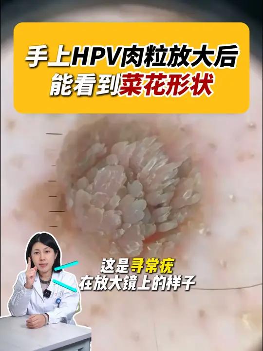 这是寻常疣在放大镜下的样子,可以试试在家这样处理