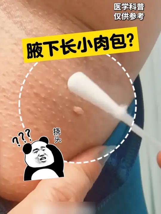 脖子或腋下长这种小肉粒,别担心,不是HPV感染!