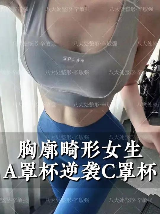 天生鸡胸的A罩杯女生,从小不自信,不敢挺胸走路,隆胸后成功逆袭到C罩杯,整个人气质提升很大