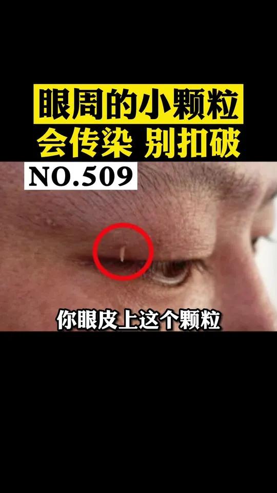 眼皮上长了细细的小肉丝,会传染,千万不要用手去抠