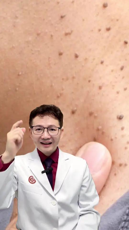 脖子上的“丝状疣”到底是什么?别再自己吓自己,一个视频说清楚 脖子上的小赘生物到底是什么?