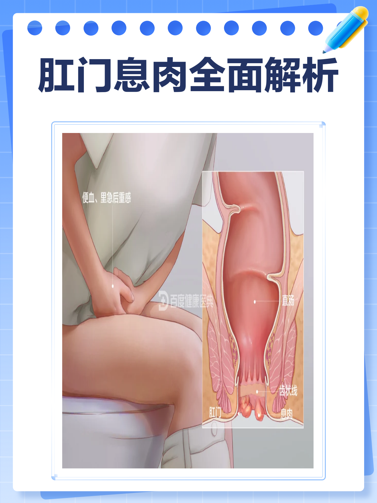 肛门息肉知多少?一文带你全面了解!