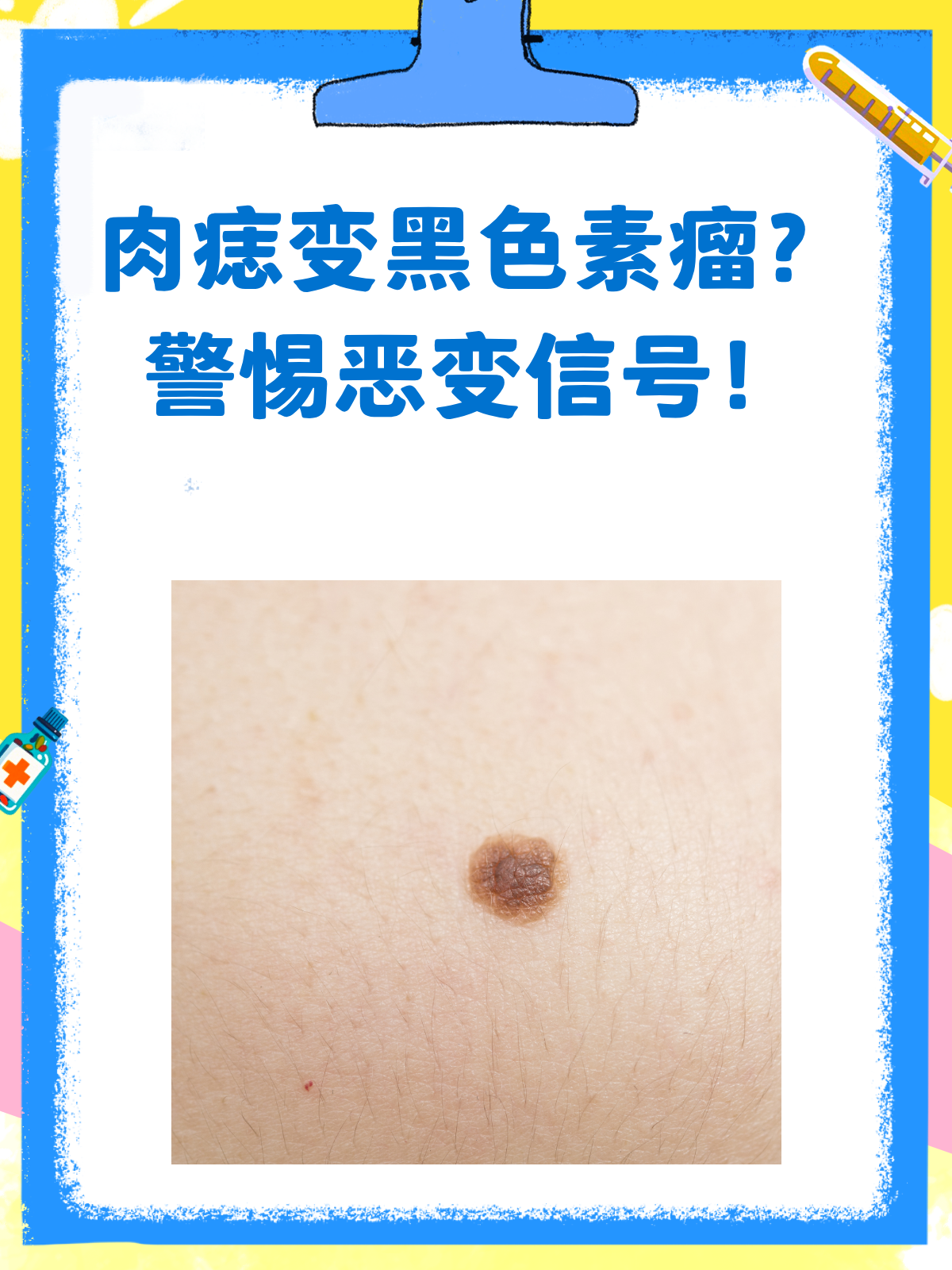 警惕!肉痣≠黑色素瘤,但也可能恶变!