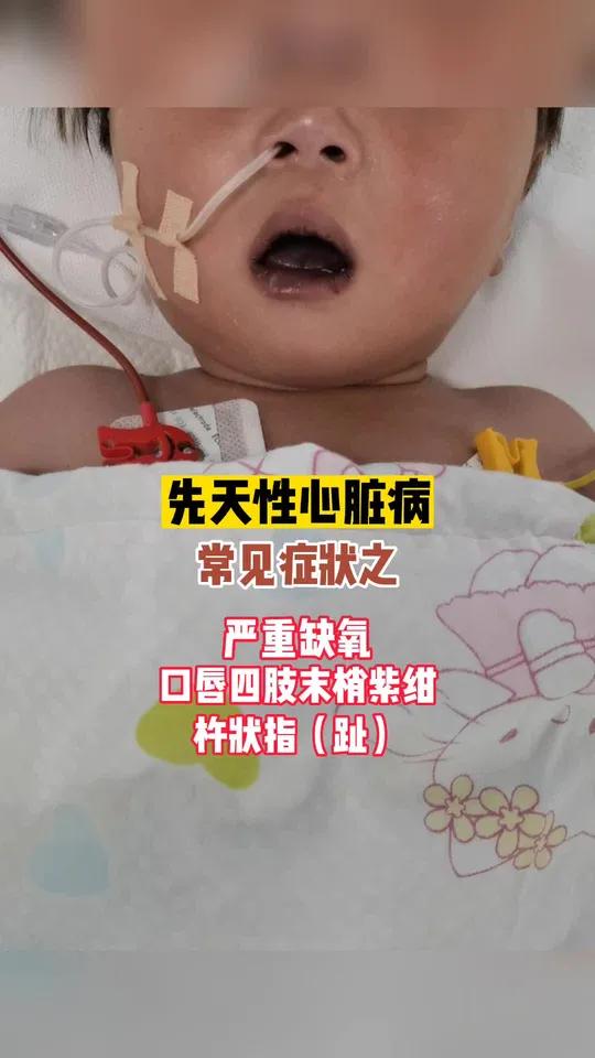 先天性心脏病常见症状之严重缺氧、口唇四肢末梢紫绀、杵状指(趾)