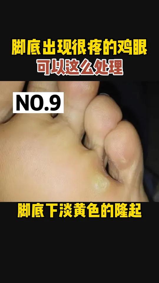 脚底长鸡眼,走起路来特别疼,特别磨脚,还很难自己好