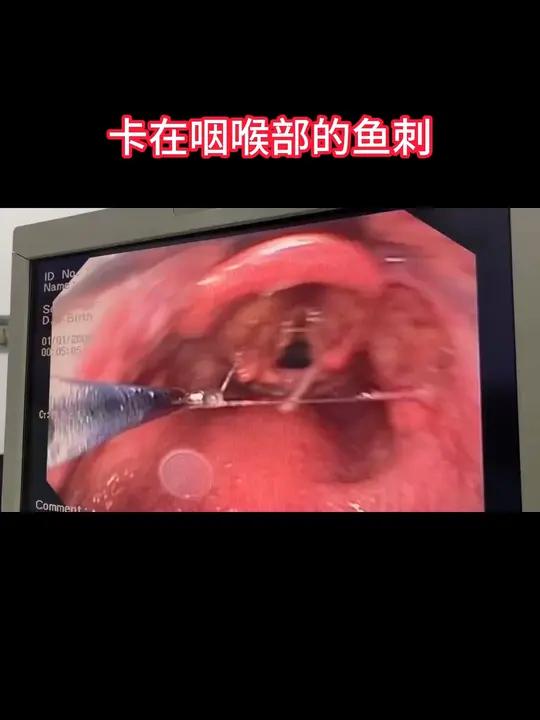 卡在声门入口处的鱼刺,电子喉镜下取出,这样的事耳鼻咽喉经常碰到