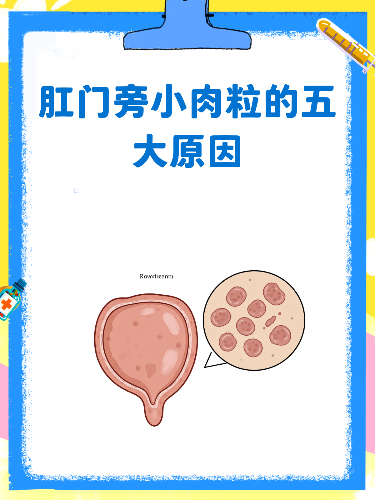 肛门旁小肉粒，揭秘五大元凶！