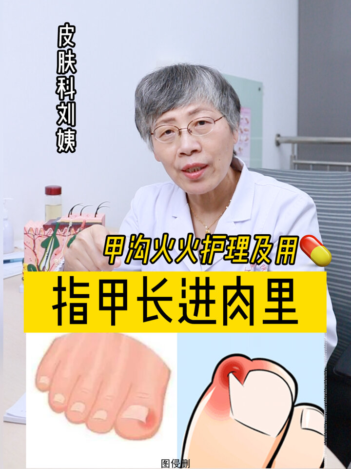指甲长进肉里,你剪指甲就没剪对啊