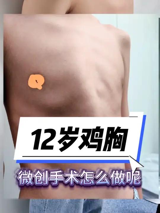 12岁鸡胸,外观比较明显