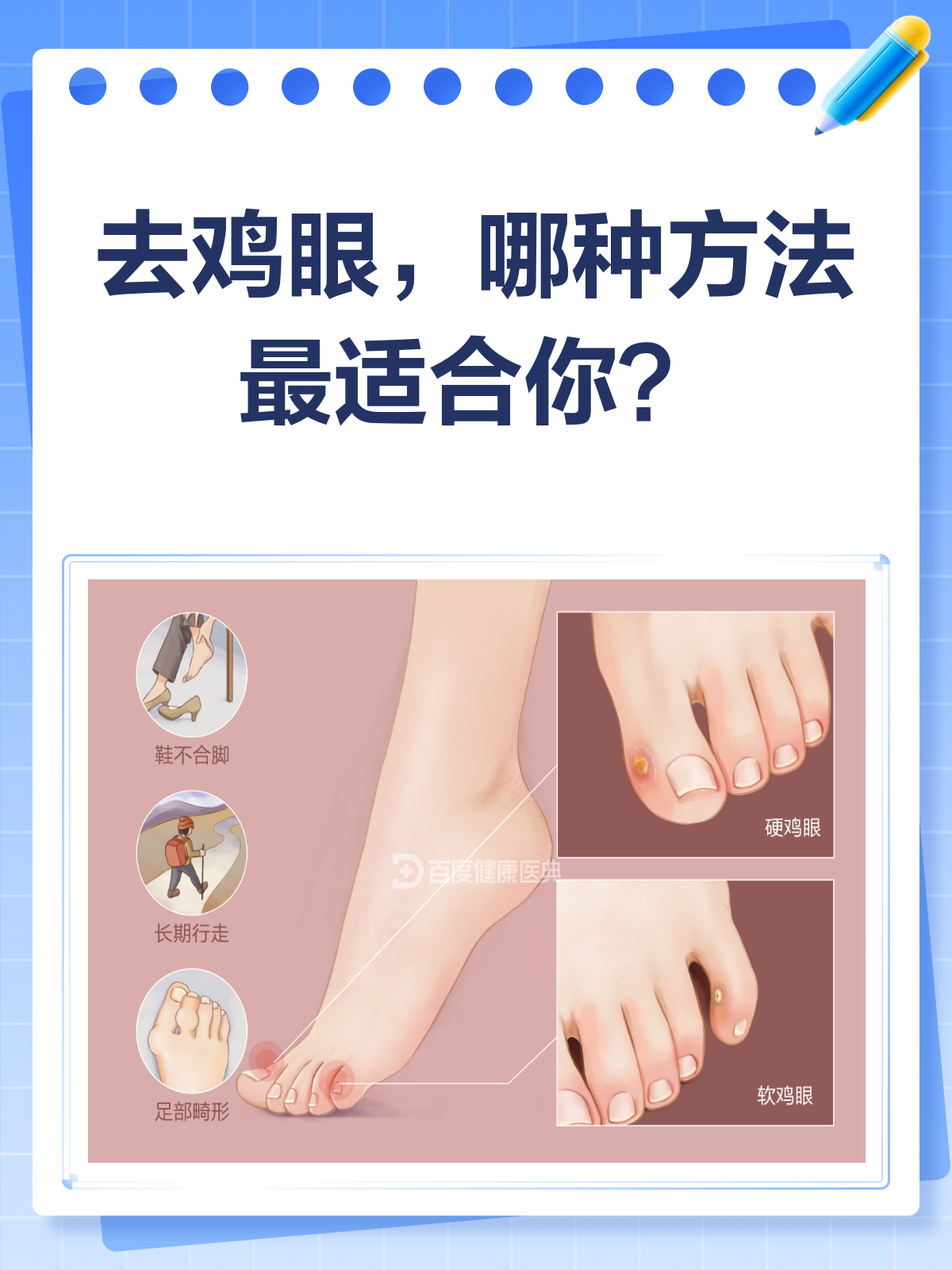去鸡眼哪种方法最快?看这篇就够了!