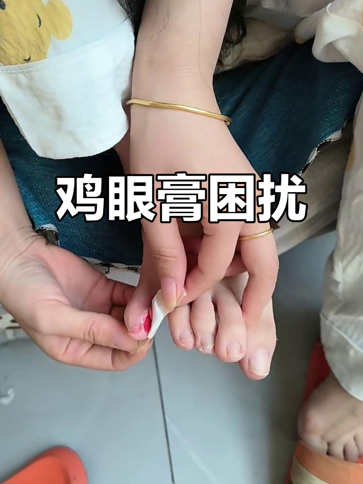 鸡眼膏大小不匹配,贴起来真是头疼!