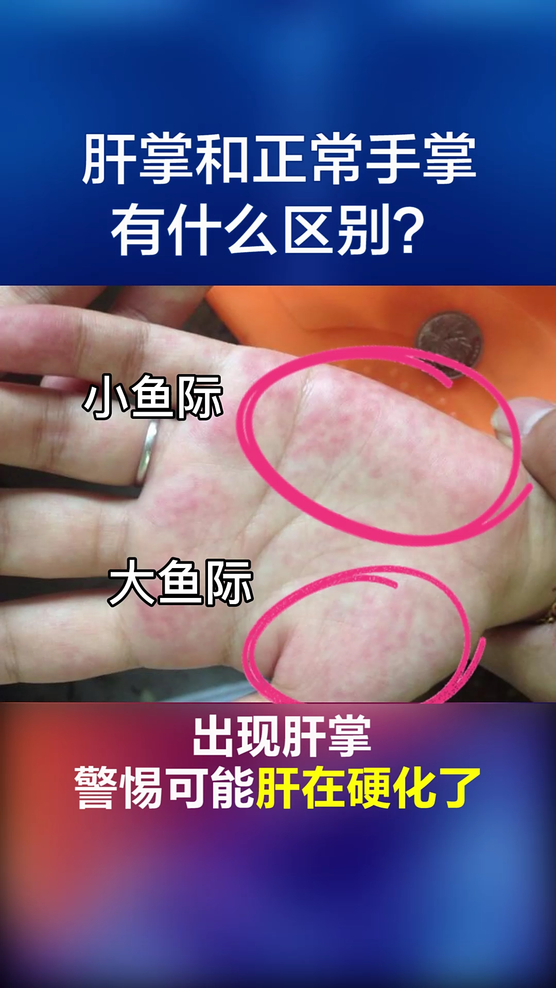 肝掌和正常手掌有哪些区别？快对照着看看