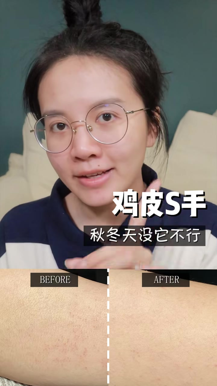 最全鸡皮肤消灭大法