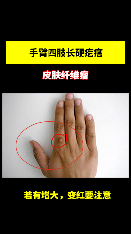 皮肤上长小肉球,这是皮肤纤维瘤,若是出现增生或者长红斑就要注意了