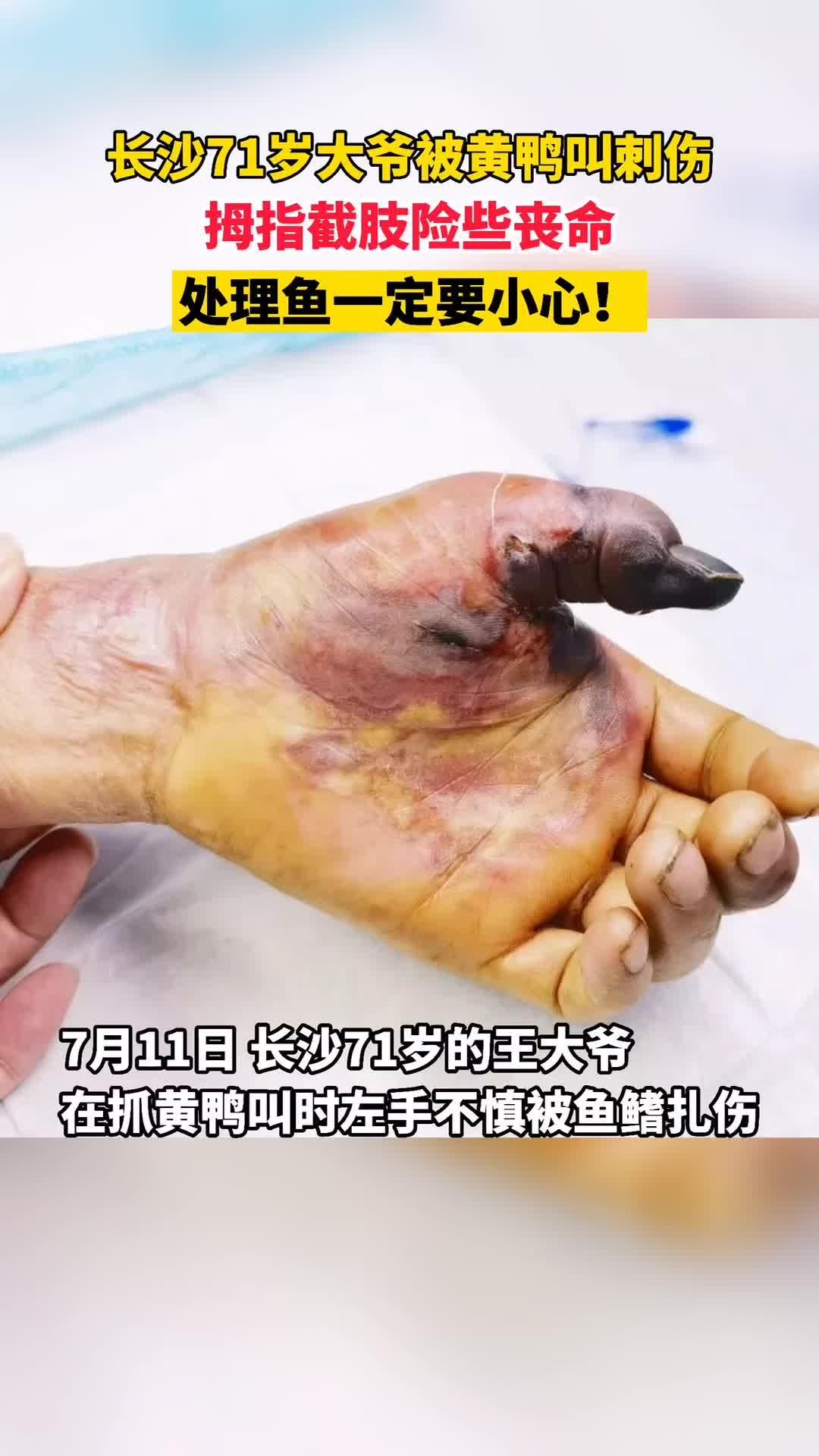 71岁大爷被黄鸭叫刺伤,拇指截肢险些丧命,处理鱼一定要小心!