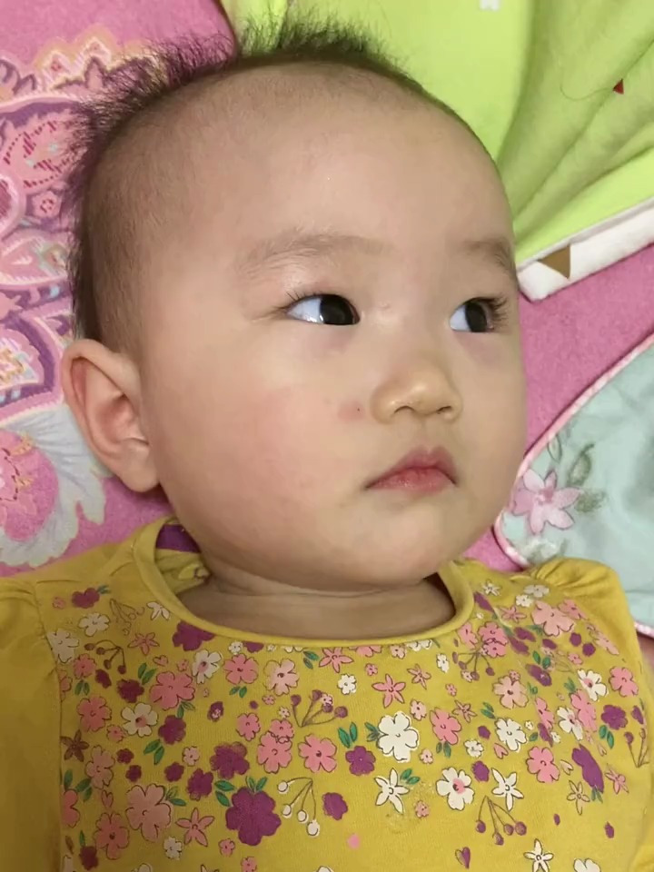 您家宝宝出过幼儿急疹吗?