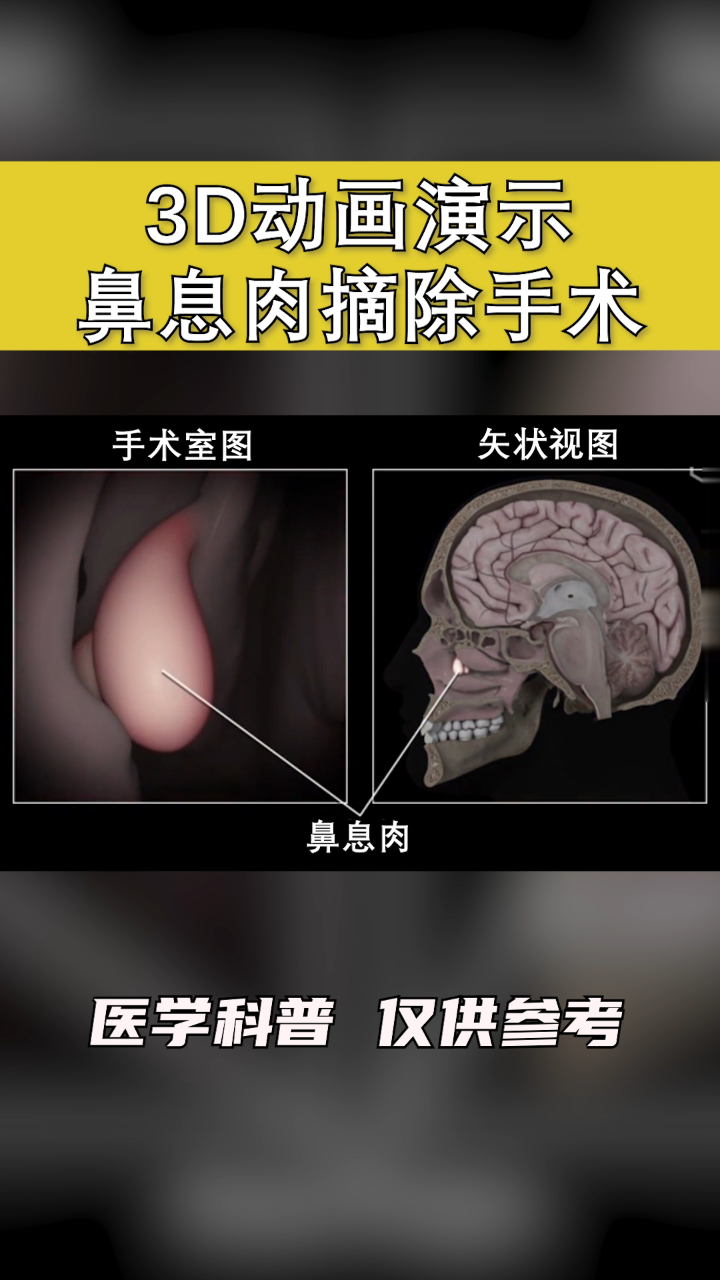 鼻息肉切除手术,一个视频带你看全过程,看完你还敢做吗?