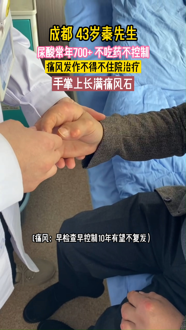 尿酸常年700+,不吃药不控制,手掌上长满痛风石