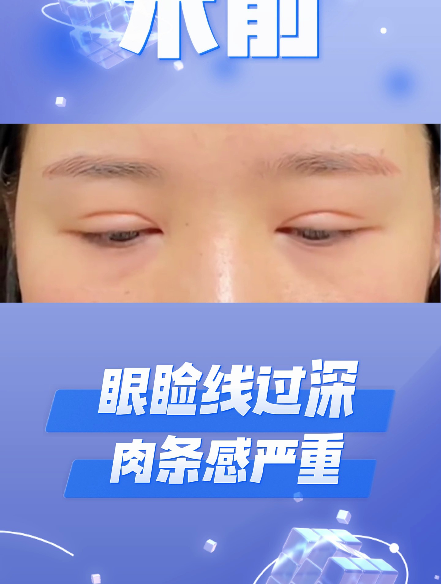 姑娘双眼皮眼睑线过深,肉条感严重,来看看修复后的效果吧!