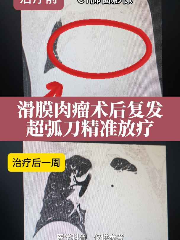 滑膜肉瘤术后复发,超弧刀精准放疗,放疗最好的是什么刀?