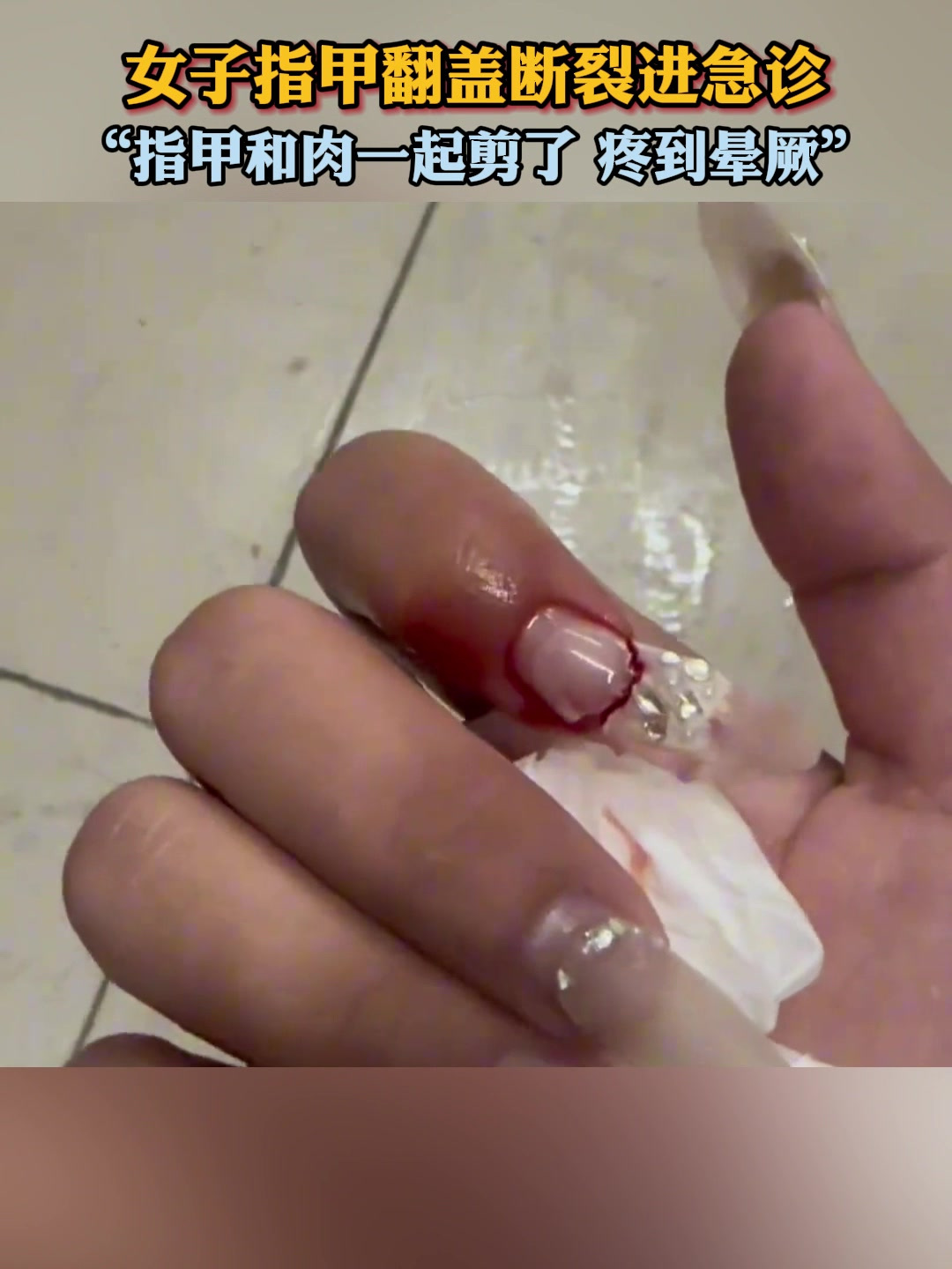 女子指甲翻盖断裂进急诊,“指甲和肉一起剪了 疼到晕厥”!