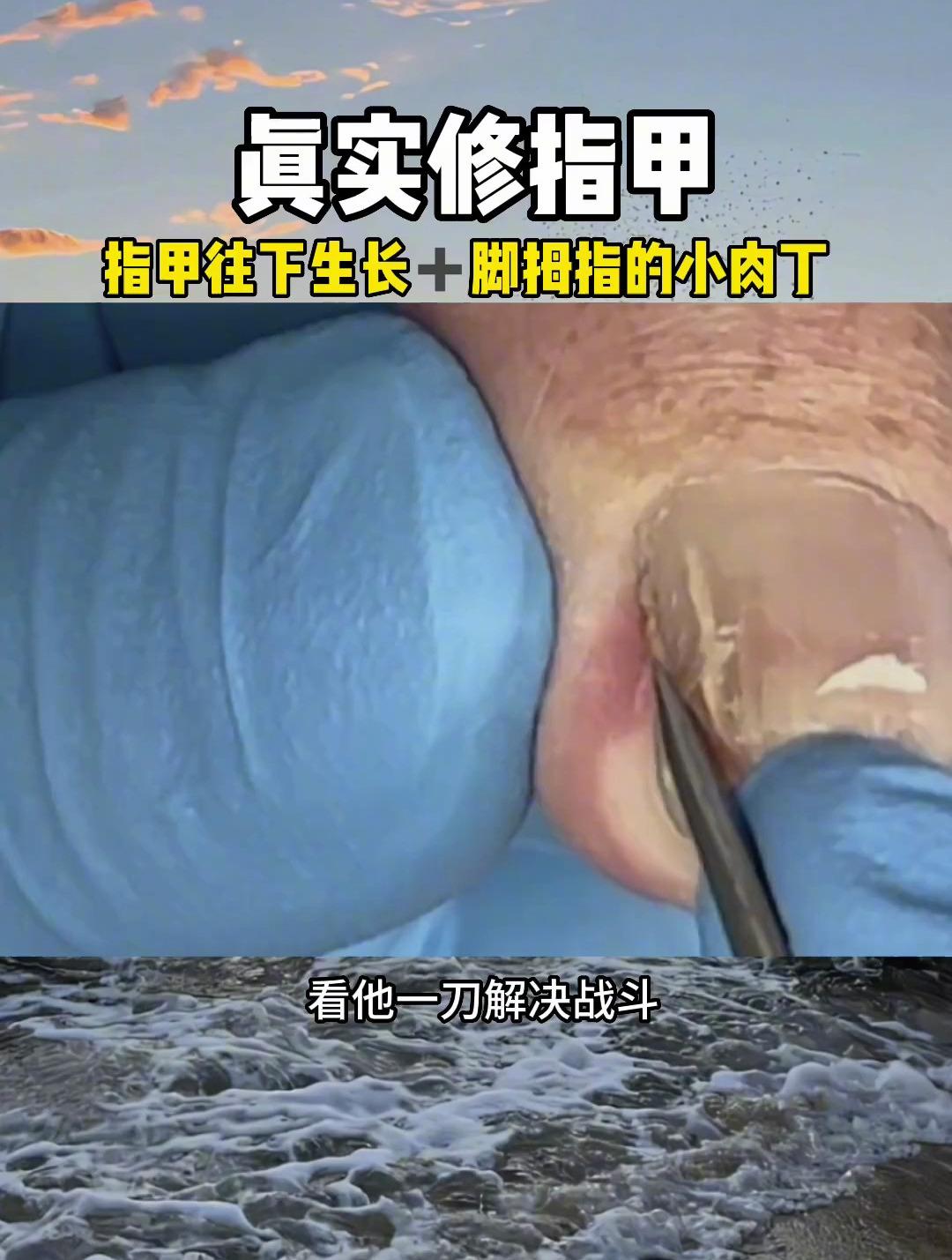 大姨的脚有两个困扰,帮大姨解决完大姨很开心