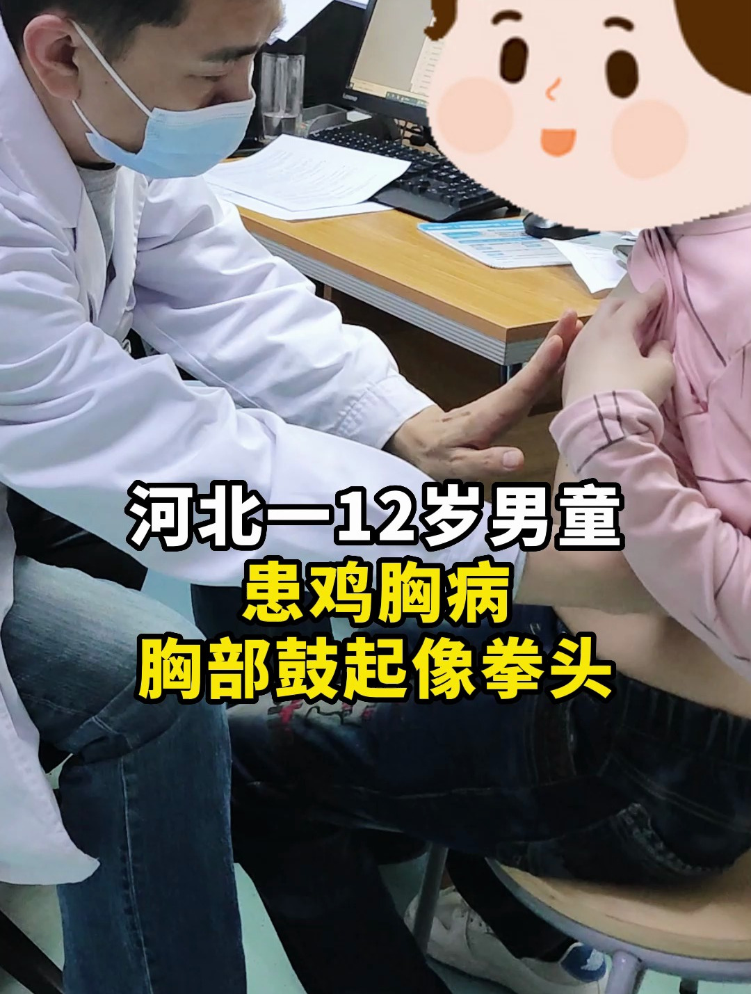 河北一12岁男童患鸡胸病,胸部鼓起像拳头
