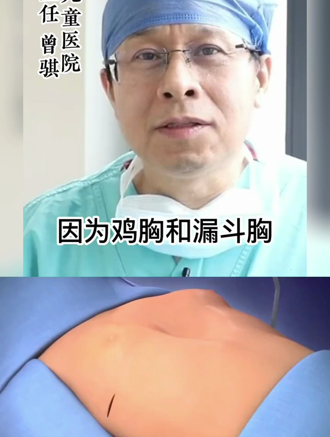 鸡胸和漏斗胸是儿童最常见的胸壁畸形