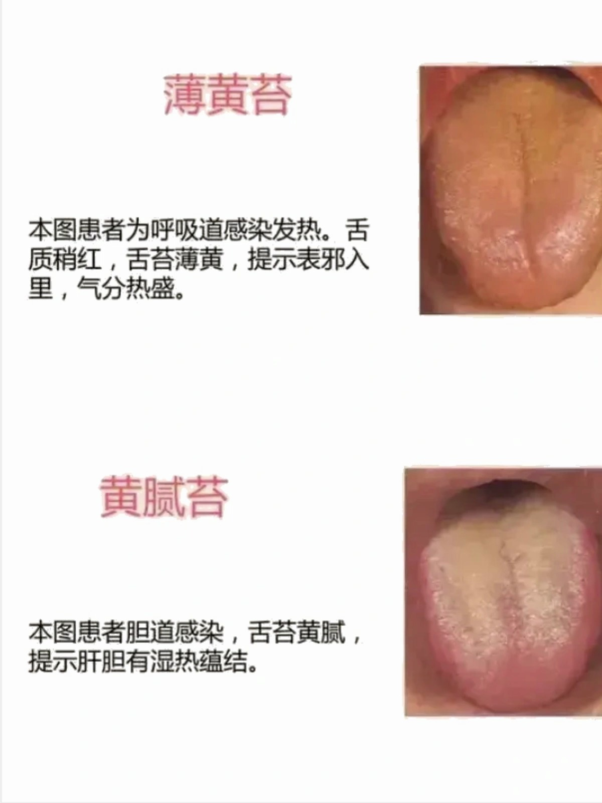 不同舌苔颜色,对应不同病!
