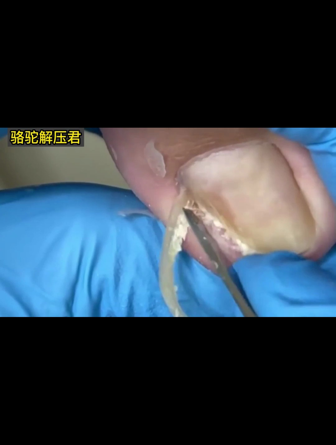 坚强的小男孩,常年鞋子不合脚导致小男孩指甲长肉里!