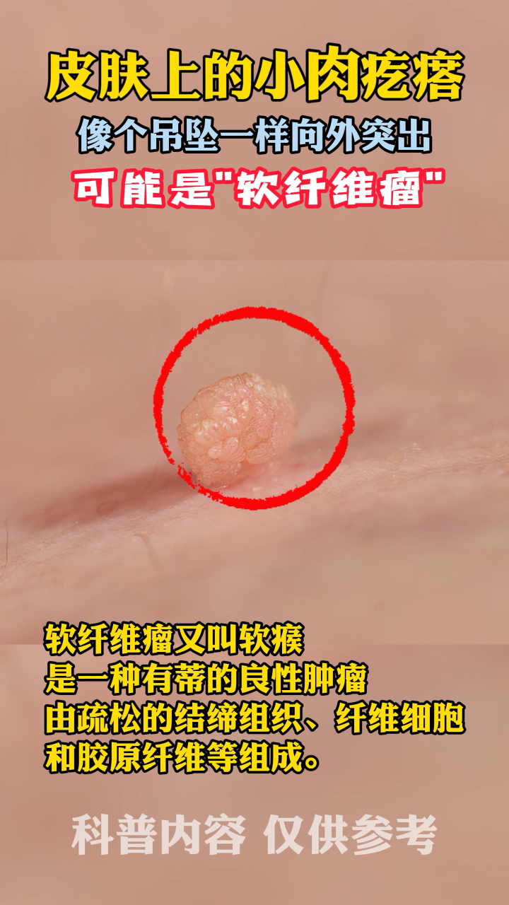 皮肤上这样的小肉疙瘩,像吊坠一样!看看你有吗?