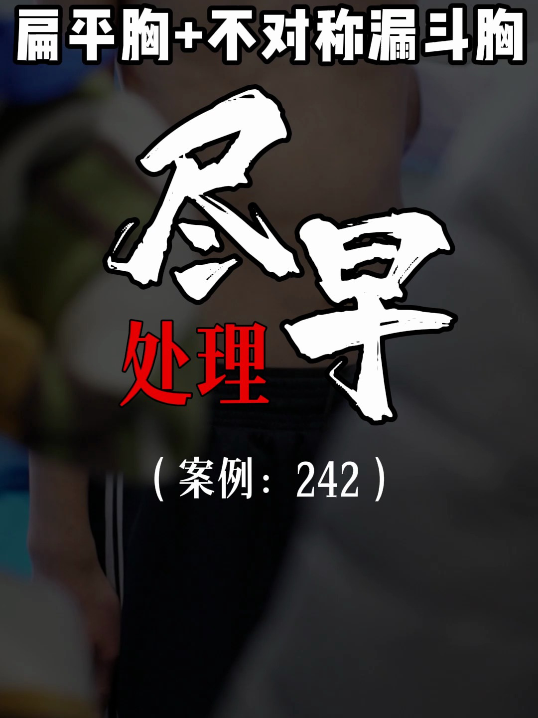 漏斗胸鸡胸医生张东升